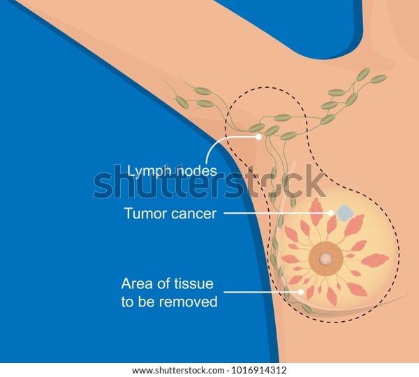 Mastectomy Breast Cancer Axillary Lymph Node Stock Vector (Royalty Free ...