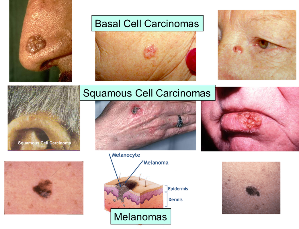 May: Skin Cancer