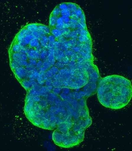 Mechanism of a breast cancer drug points to a possible new therapy ...