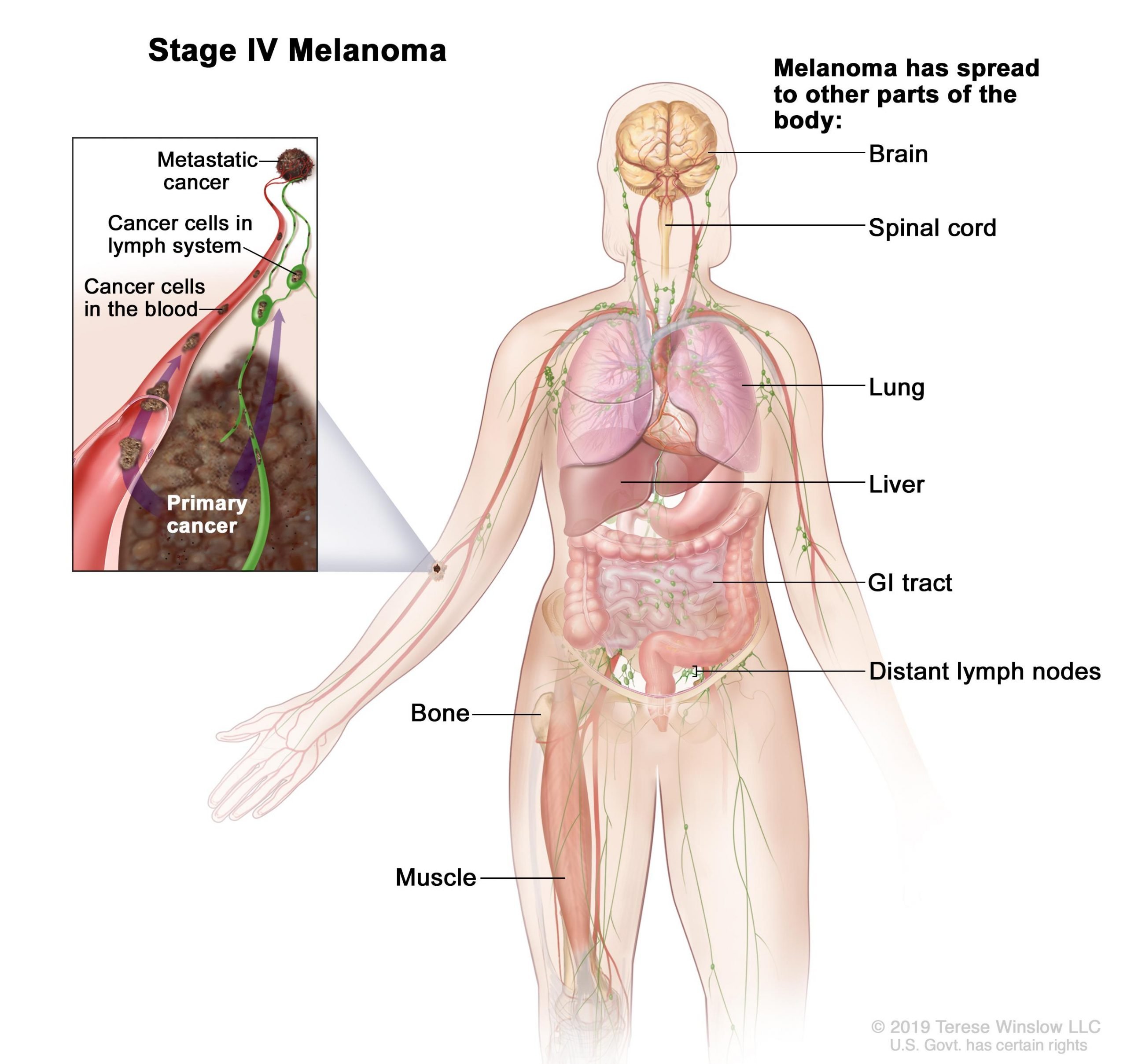 Melanoma Treatment (PDQ®)Patient Version