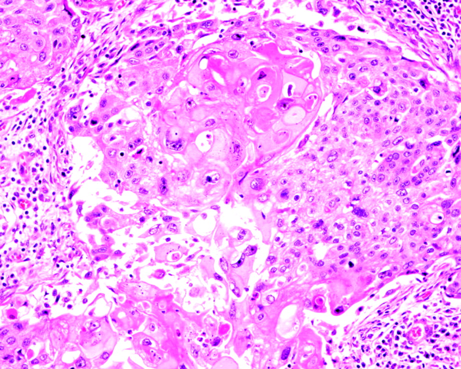 Metaplastic carcinoma of the breast: a clinicopathological ...