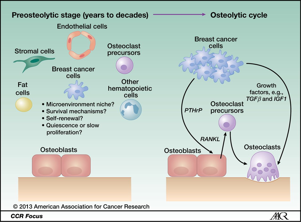 Metastasis Dormancy in Estrogen ReceptorPositive Breast ...