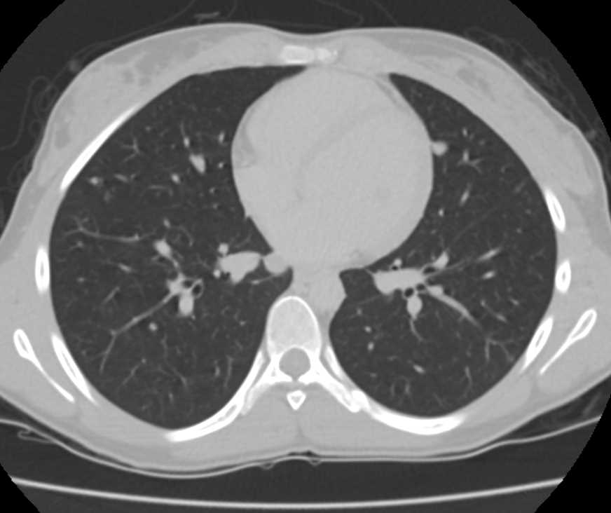 Metastatic Breast Cancer to Lung and Pleura