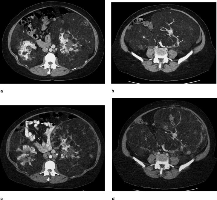 Metastatic Breast Carcinoma to Renal Angiomyolipomas in Tuberous ...