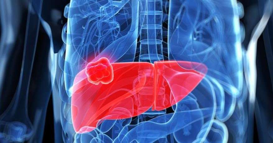 Metastatic Liver Cancer Survival Rate