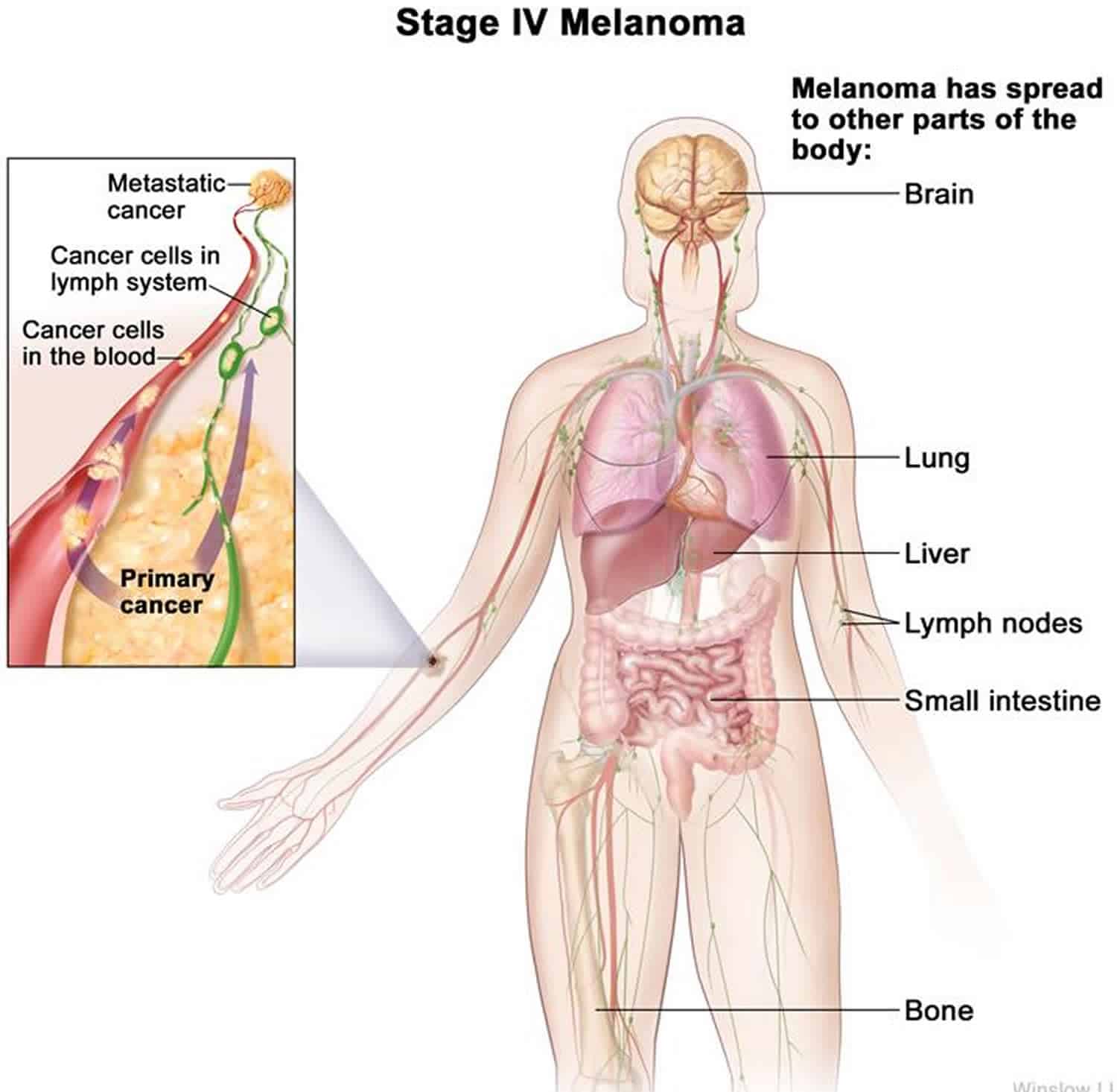 Metastatic stage 4 melanoma, life expectancy &  metastatic melanoma ...