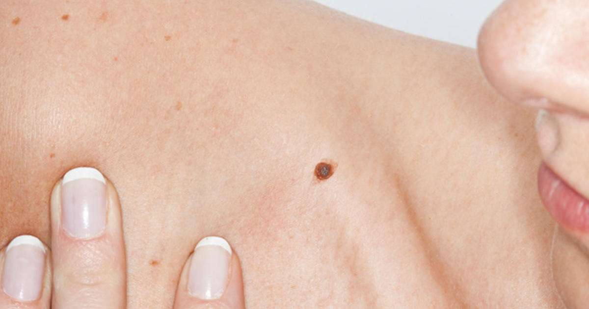 Moles may be sign of higher breast cancer risk