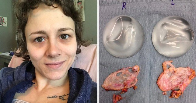 Mum has breast implants removed after claiming they ...