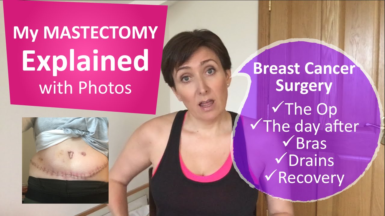 My breast cancer lumpectomy, mastectomy and reconstruction ...