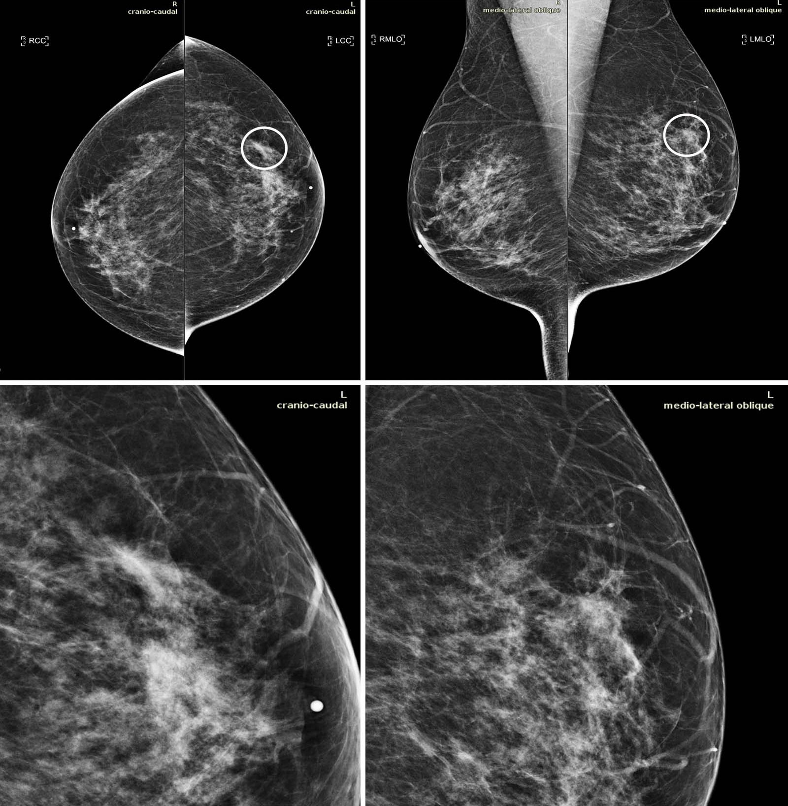 New Artificial Intelligence Tool Improves Breast Cancer Detection on ...