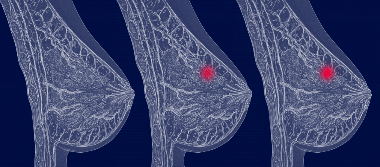New genetic analysis reveals late spread of breast cancer and backs key ...