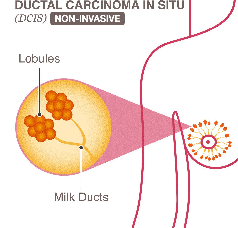 New Technique Identifies Ductal Carcinoma In Situ, Breast ...