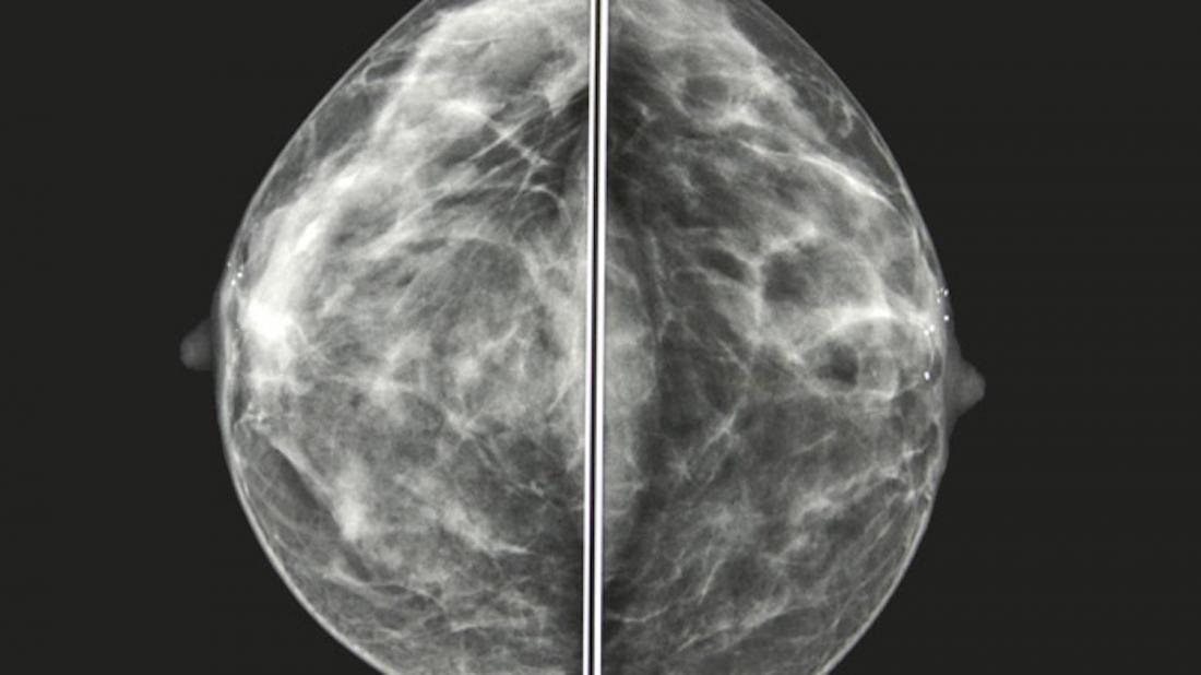 Nodule In Breast On Ct Scan
