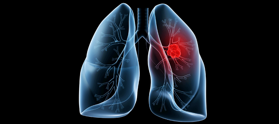 Novel mechanism of pleural effusion in lung cancer ...