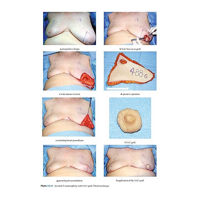 Oncoplastic and Reconstructive Surgery for Breast Cancer Buch