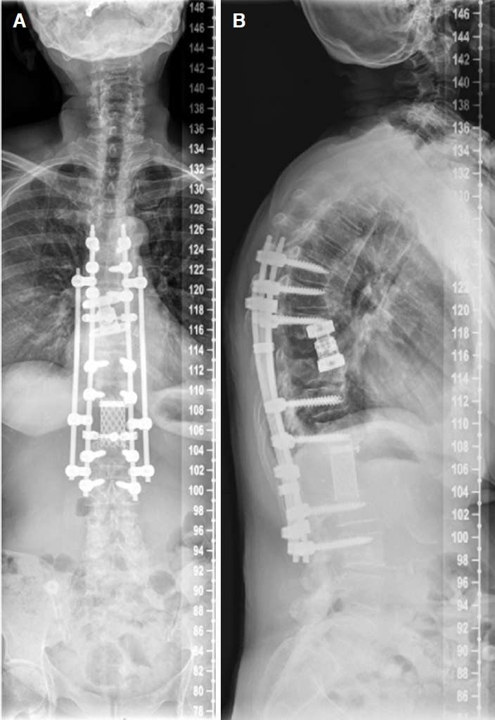 Operative treatment of metastatic breast cancer in the spine with ...