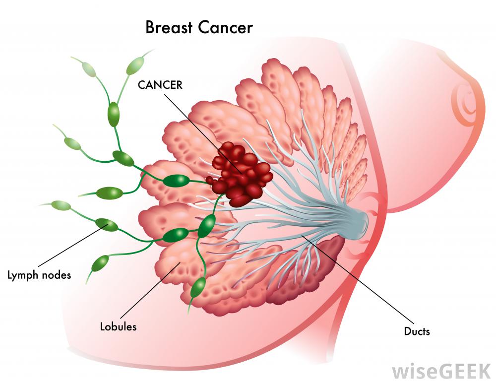 Pain following Breast Cancer Surgery?