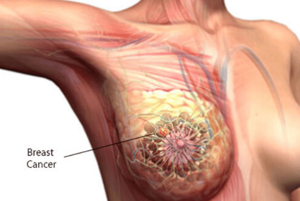 Pain Under Left Breast: 18 Causes with Treatments