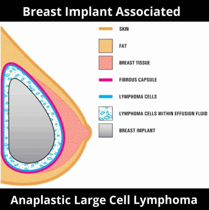 Pin on Breast Implant Illness