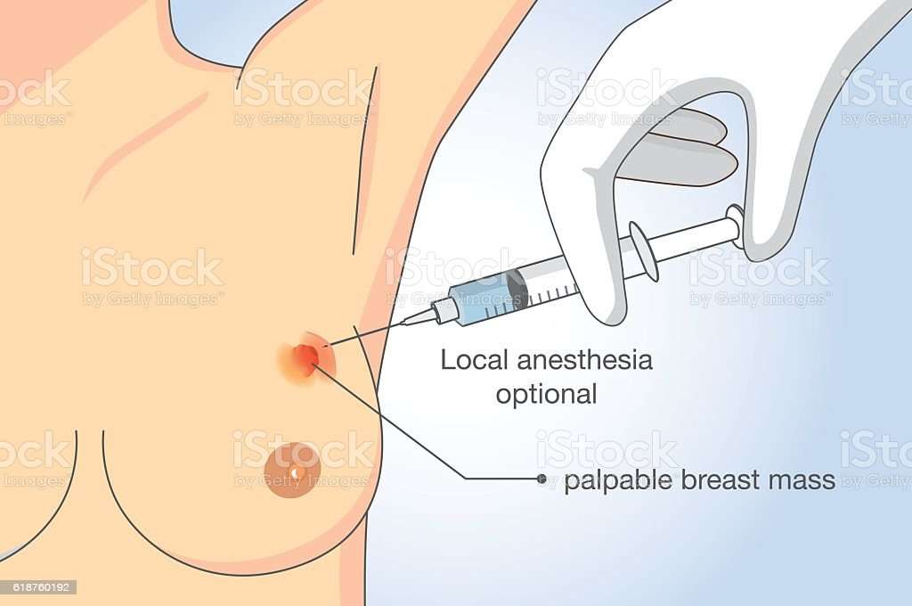 Procedure To Test For Breast Cancer Stock Illustration ...