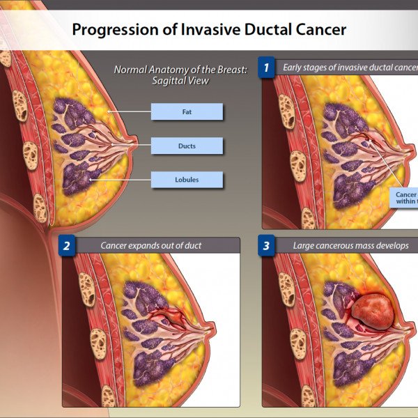 Progression of Invasive Ductal Cancer