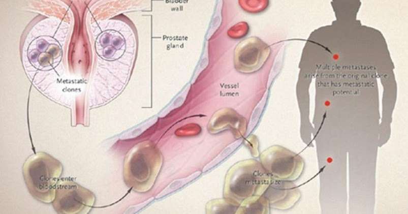 Prostate Cancer Life Expectancy