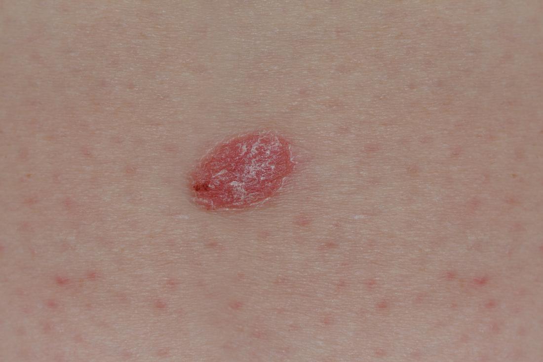 Psoriasis or skin cancer? How to tell the difference