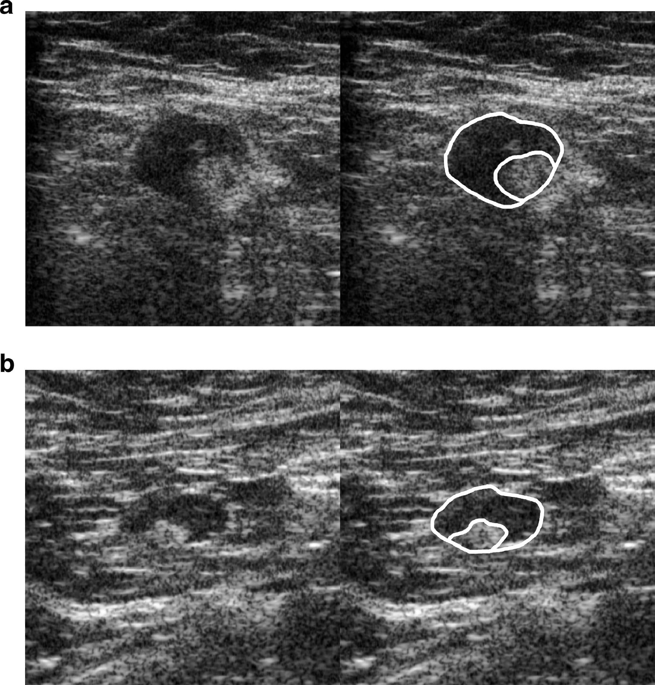 Quantitative Ultrasound Image Analysis of Axillary Lymph Nodes to ...