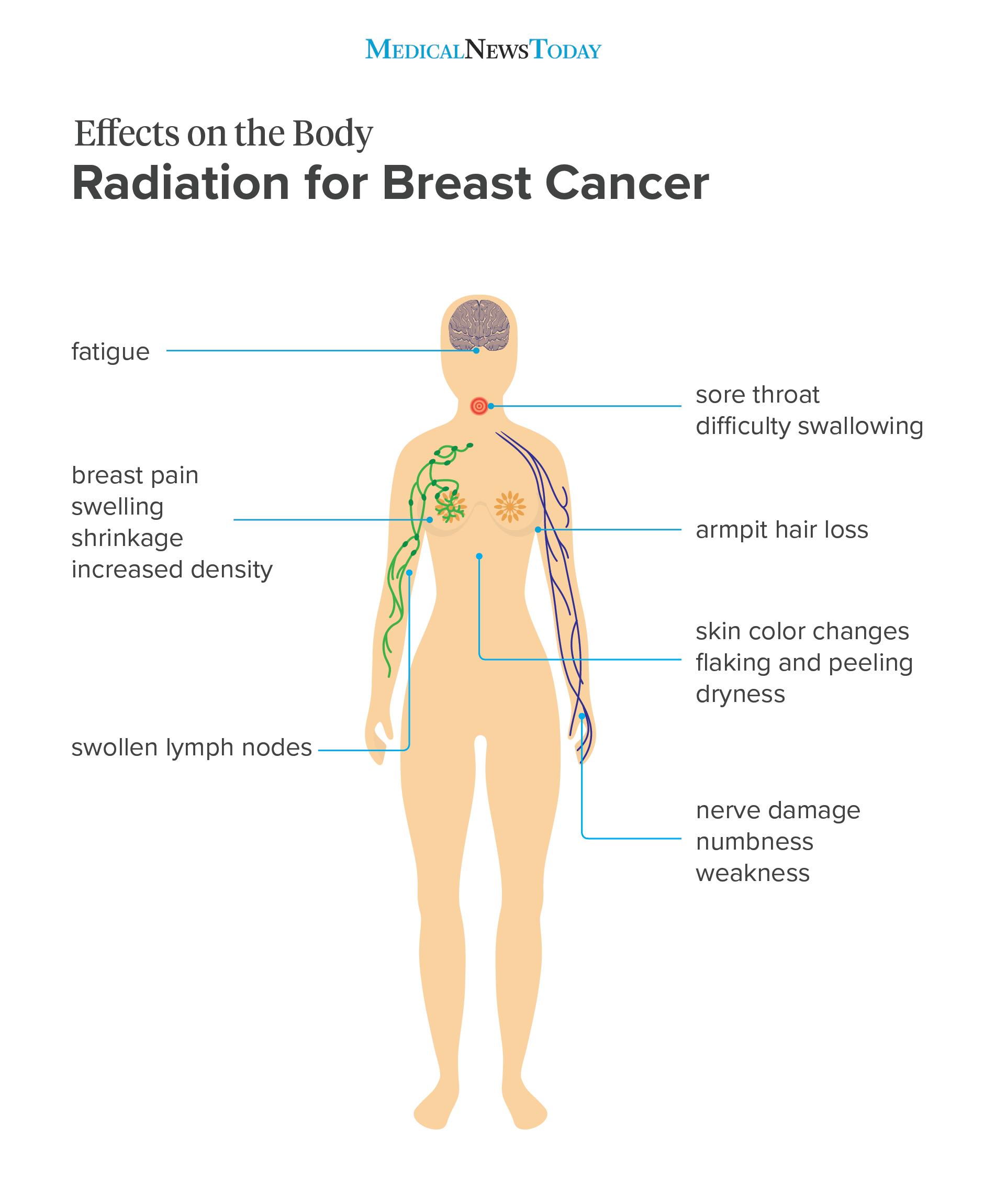 Radiation Therapy For Breast Cancer Long Term Side Effects ...