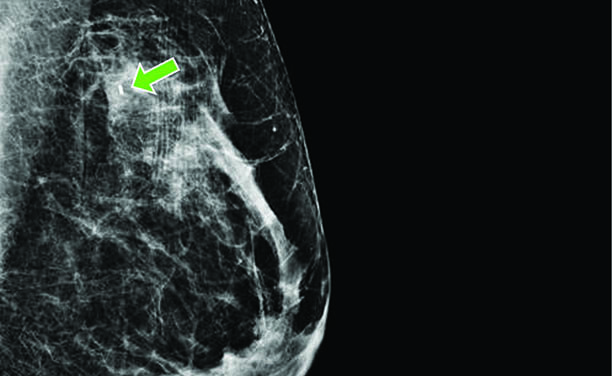 Radioactive seeds increase surgical accuracy for breast cancer patients ...