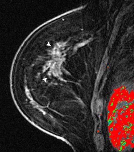 Recognizing and Interpreting Artifacts and Pitfalls in MR Imaging of ...