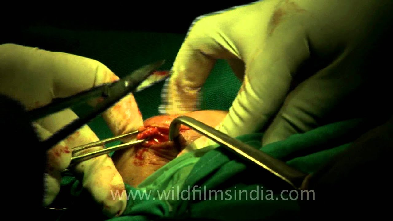 Removal of breast tumor by surgery...