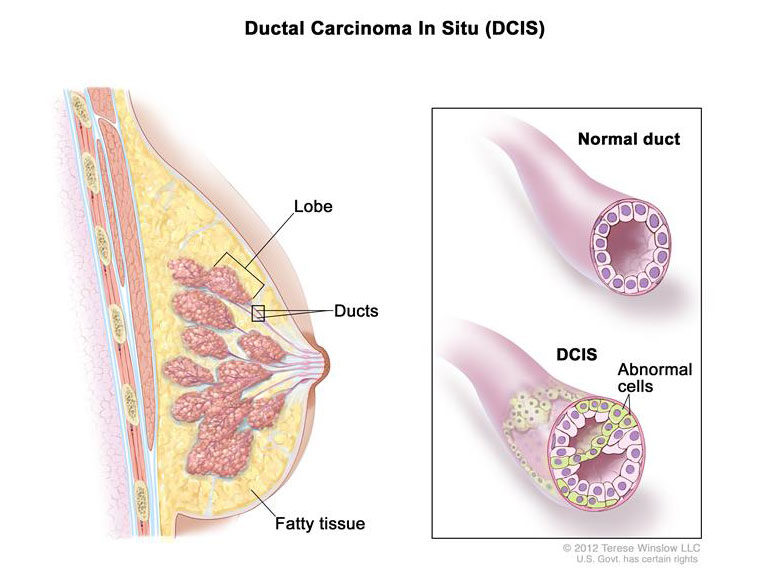 Risk of Breast Cancer Death is Low After DCIS Diagnosis ...