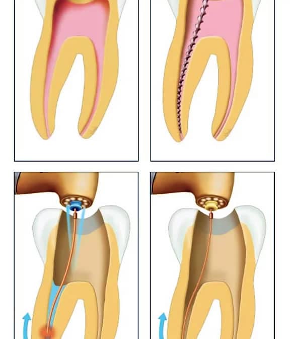 Root Canals â mbcosmeticdentistry.com