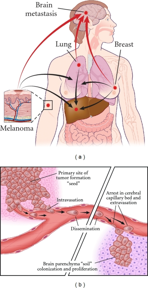 Schematics of the process of metastasis. (a) Formation ...