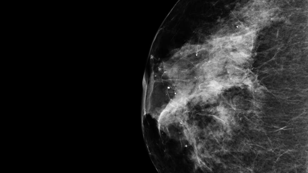 Scientists map genome for deadliest form of breast cancer