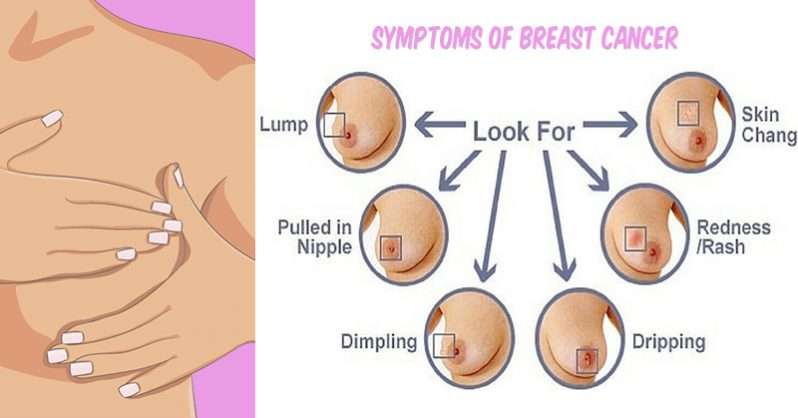 Self Examination of Breast Cancer and Screening