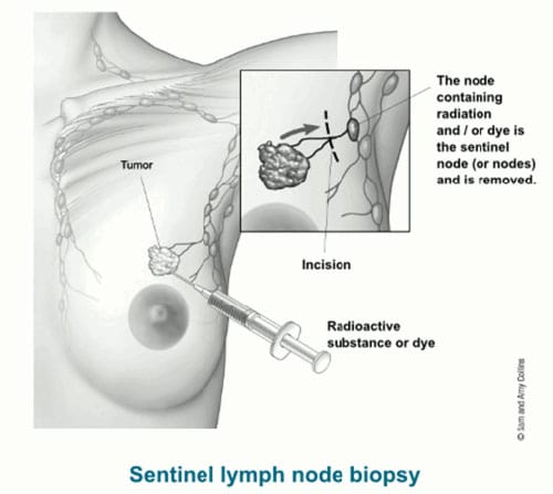 Sentinel lymph node in breast cancer treatment