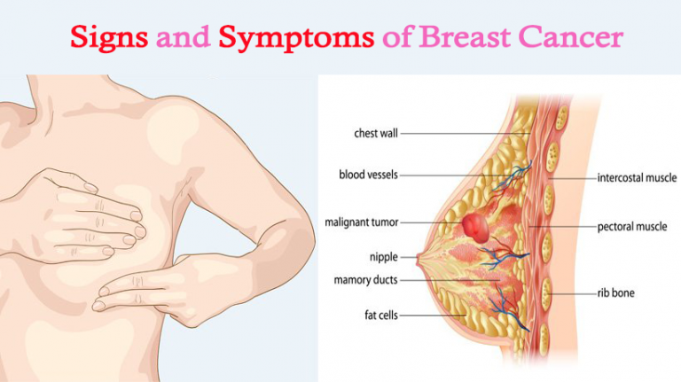 Signs and Symptoms of Breast Cancer  Dr. Abdu