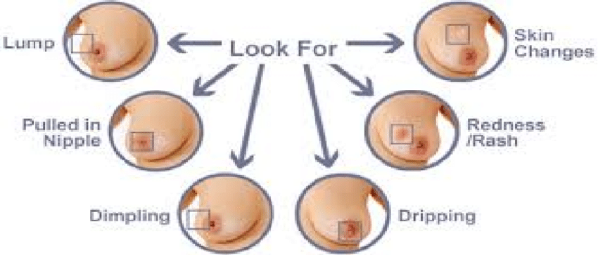 Signs of Breast Cancer
