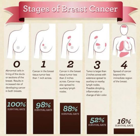 Signs of Breast Cancer Images and Facts