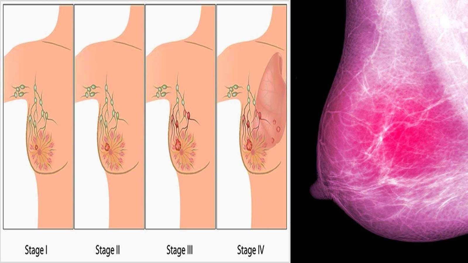 Signs of Breast Cancer Most Women Ignore