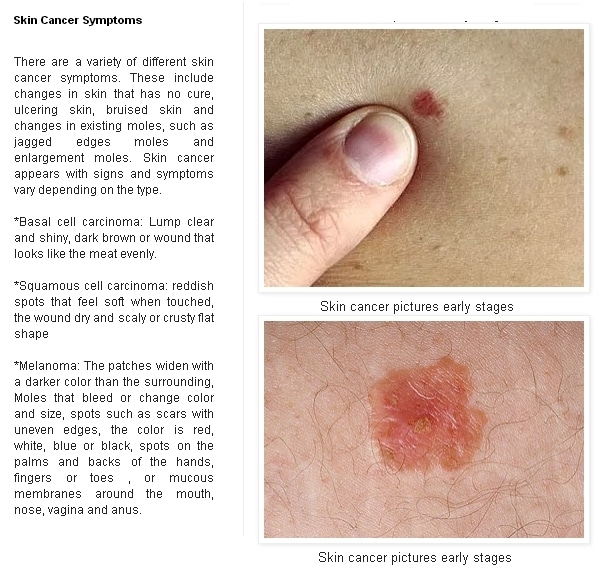 Skin Cancer Advices