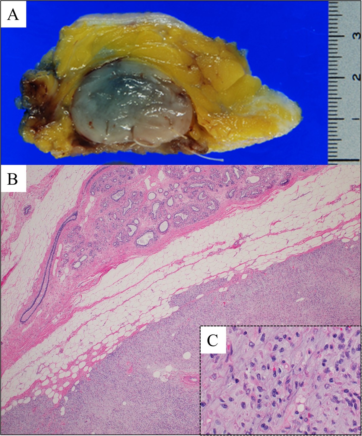 Solitary breast metastasis from myxoid liposarcoma