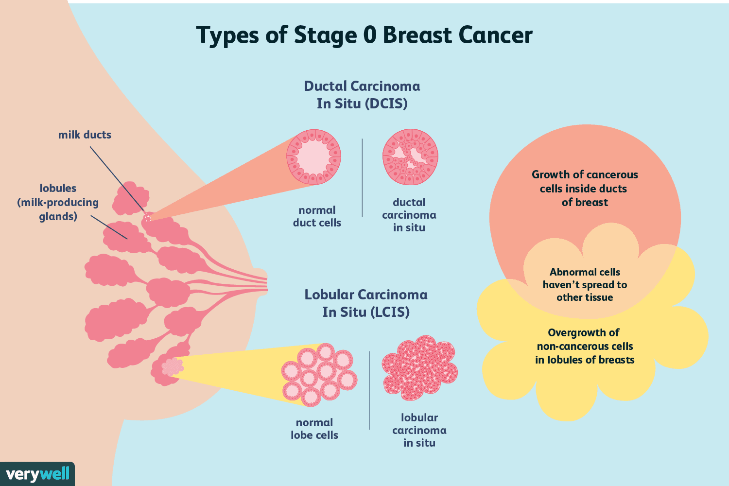 Stage 0 Breast Cancer: Diagnosis, Treatment, and Survival