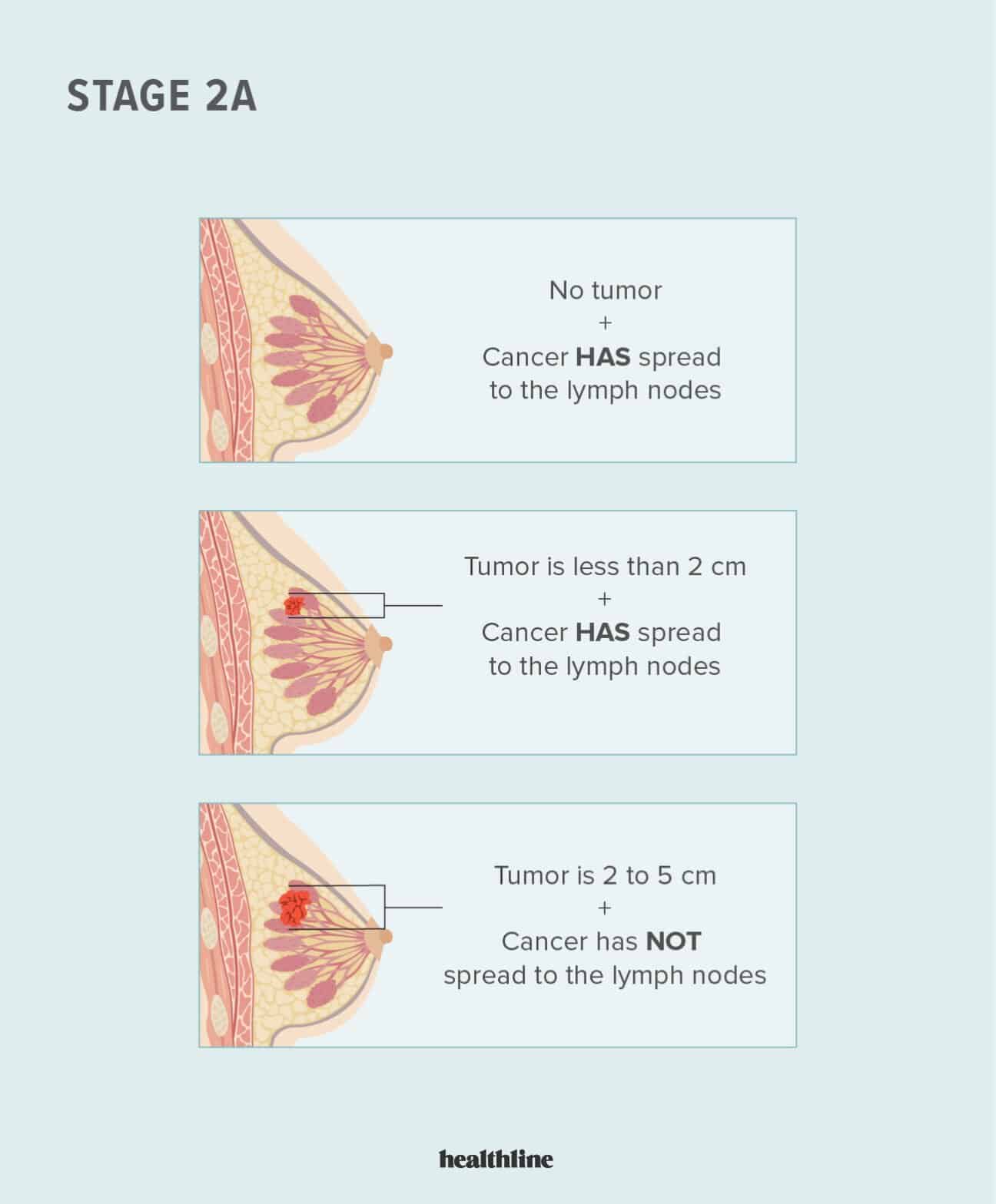 Stage 2 Er Positive Breast Cancer
