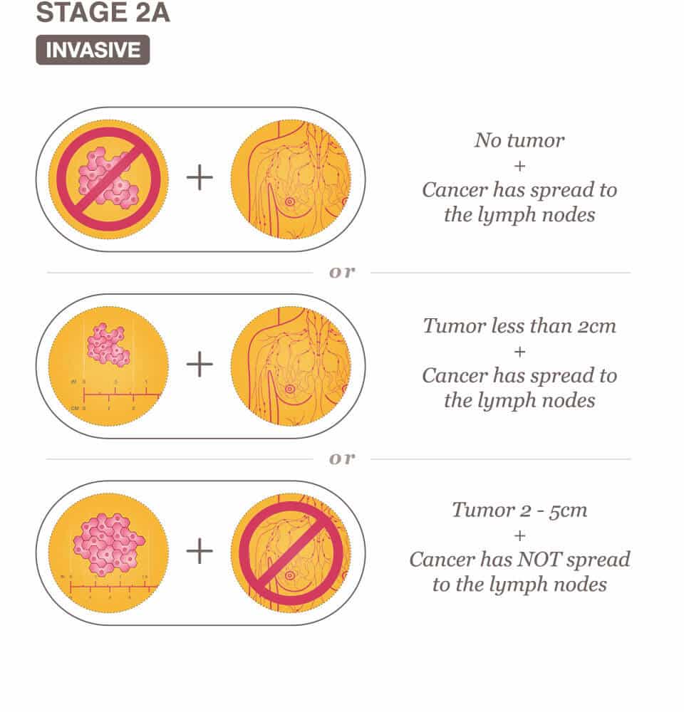 Stage 2 (II) And Stage 2A (IIA) Breast Cancer Overview