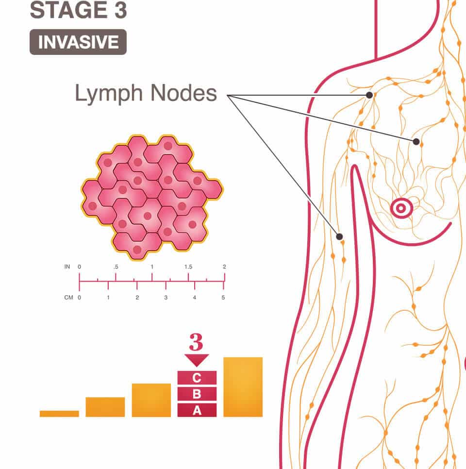 Stage 3 (III) A, B, And C Breast Cancer Overview