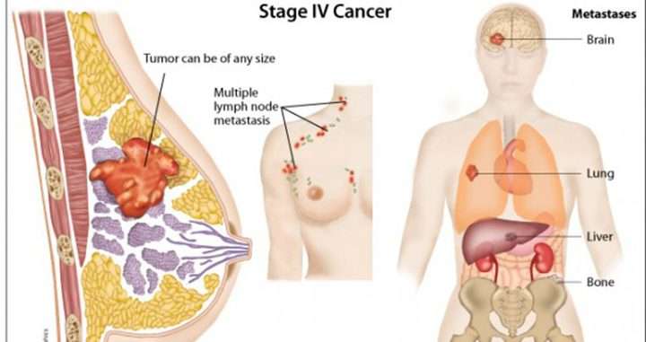 STAGE 4 BREAST CANCER IN THE LUNGS  Medicals Plan