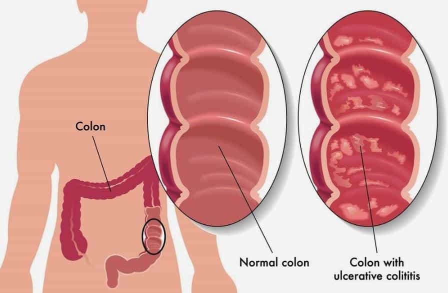 Stage 4 Colon Cancer Life Expectancy